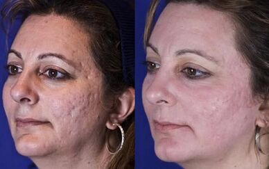 Λέιζερ κλασματική αναζωογόνηση πριν και μετά τις φωτογραφίες